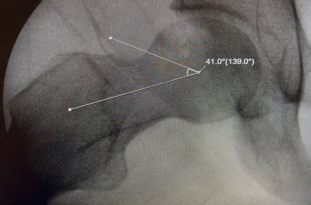 Labral tear at the right acetabulum precipitated by CAM impingement of the femoral head